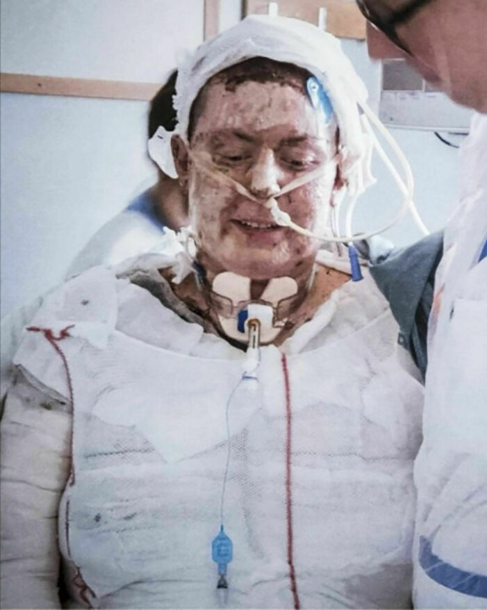 Emma svävade mellan liv och död i veckor. Foto: Privat. Emma full gipsad på sjukhuset