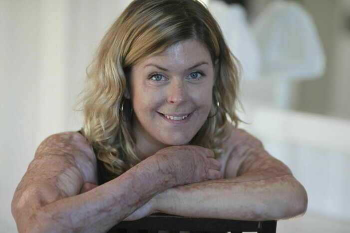 Emma genomgick totalt 70 hudtransplantationer. Foto: Frida Funemyr. Emma Schols visar upp sina brännskador på armarna