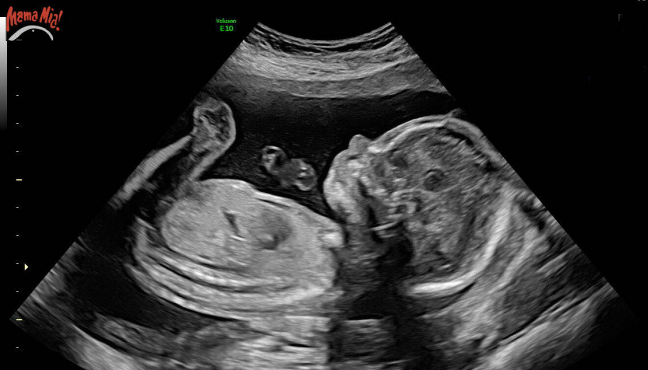 Ultraljudsbild på bebis