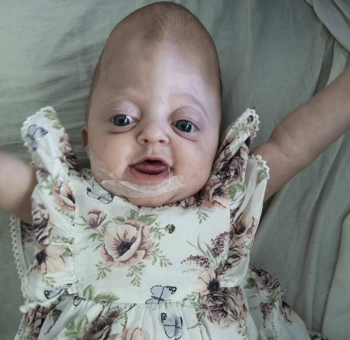 Det från början höga, smala huvudet har efter operationer fått ett rundare utseende. Maylie Collin har Crouzons syndrom. Från början hade hennes huvud en spetsigare form.