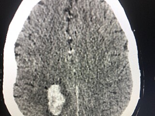 Röntgenbild på Majas hjärnblödning.