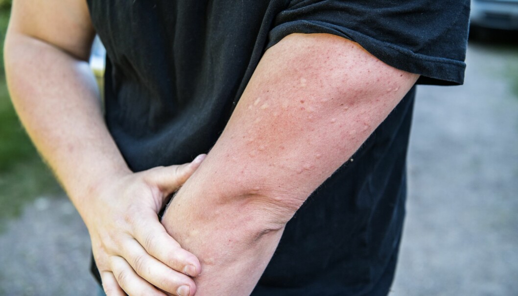 Knottbett ser ofta ut som myggbett men man brukar få fler på en gång. Mygg- eller knottbett på en manlig arm.