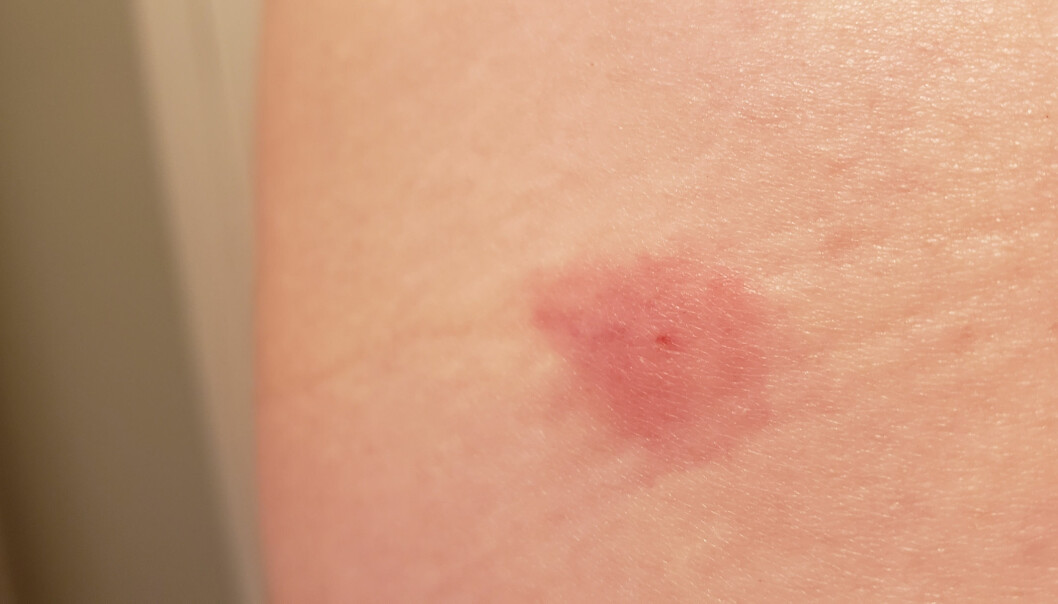 Bromsbett blir större än myggbett och man kan till och med få ett blåmärke. Lindrigt bromsbett på en bit hud.
