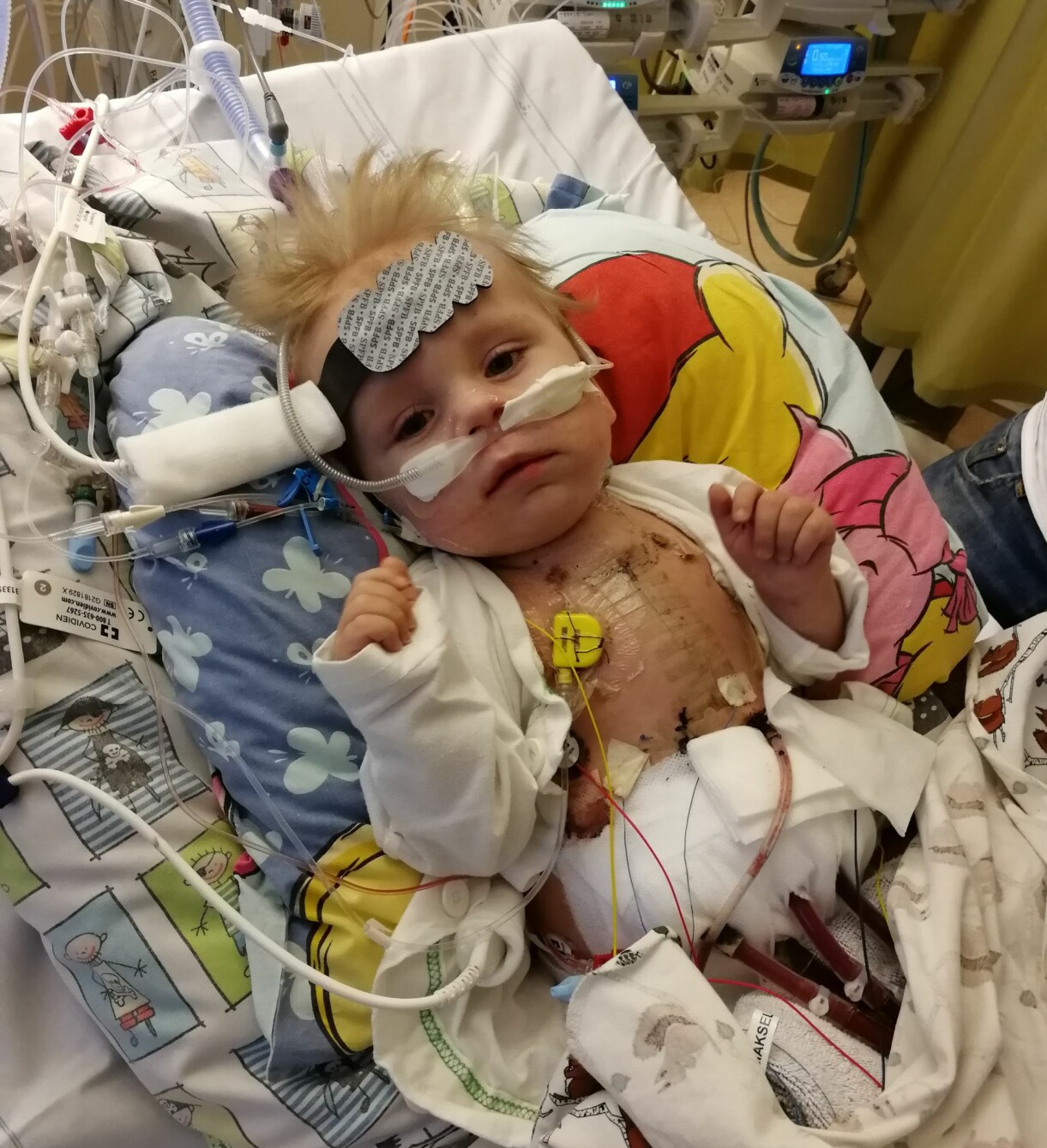 Tim fick behandling med ECMO som syresätter blodet utanför kroppen. Tim Barthelson på sjukhuset i göteborg