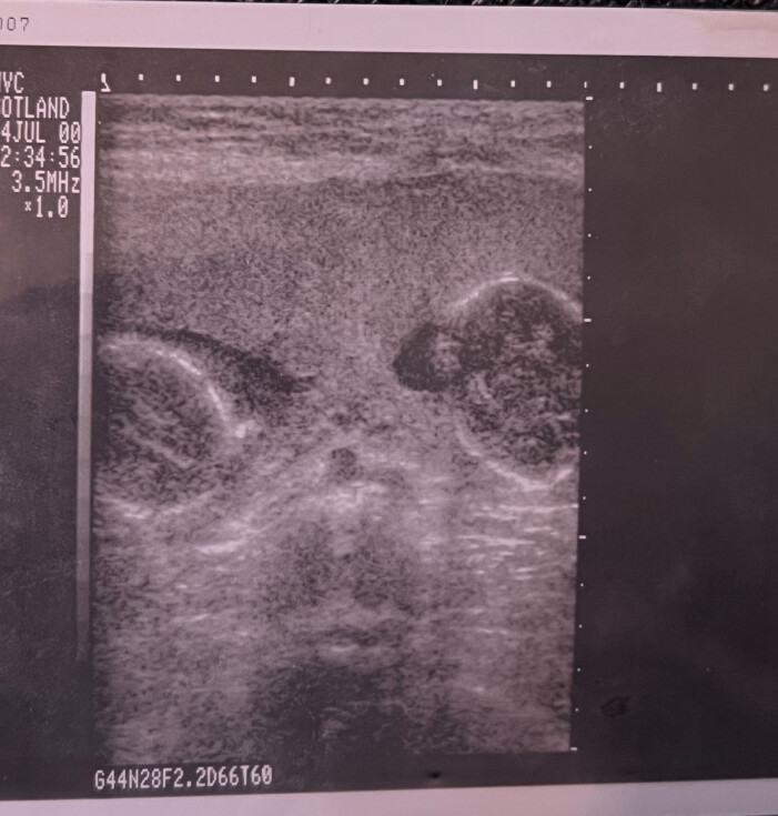 ultraljudsbild på tvillingar